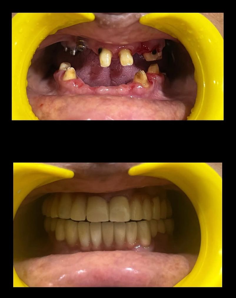 Full Mouth Implants