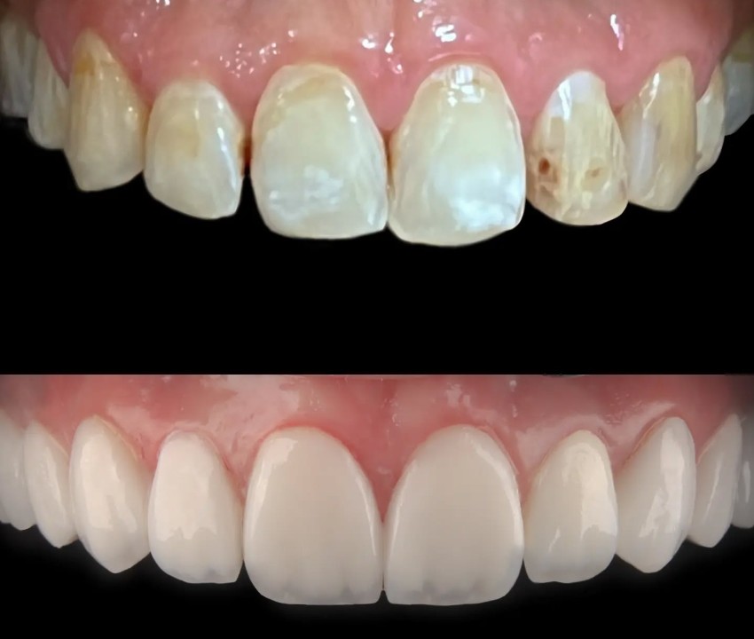 Veneers Transformation